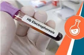 Hb Electrophoresis