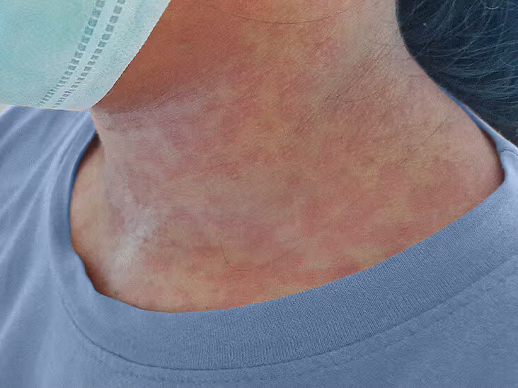 Rubella IgG 