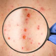 Rubella IgM