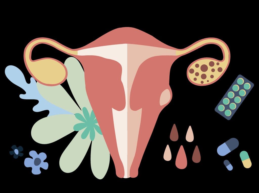 Irregular Periods and PCOS