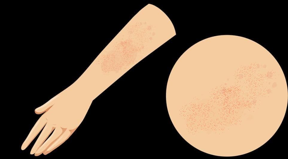 What are Hives and How to Treat Them?