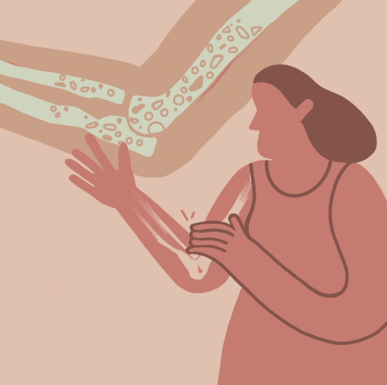 Post-menopausal Osteoporosis
